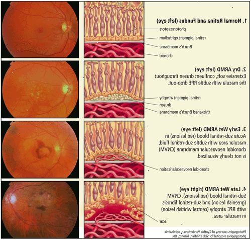 Makuladegeneration: en aldersrelateret øjensygdom. Typer af makuladegeneration - og hvordan at opdage dem.