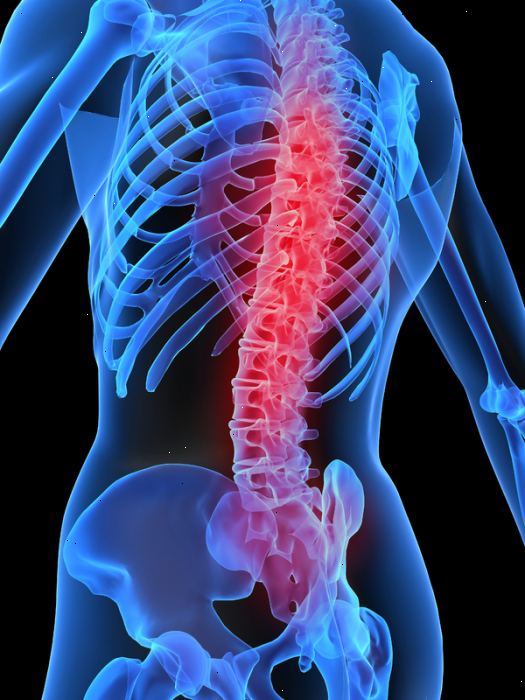 Spondylosis: når slitage årsager nakke-og rygsmerter. Find en kiropraktor eller ortopædisk specialist.