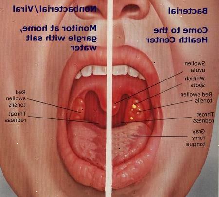 Behandling halsbetændelse. Tonsillitis typer: akut, tilbagevendende og kronisk.