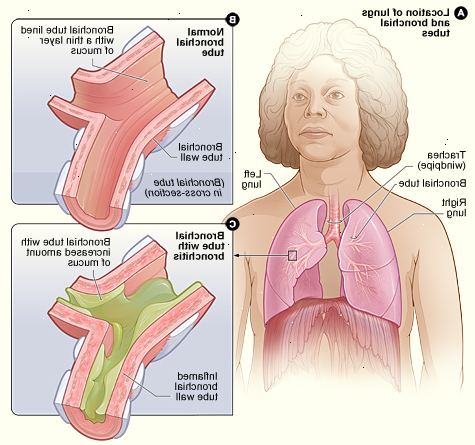 Bronkitis: når vejrtrækningen bliver en smerte. Hvad er årsagen til bronkitis?